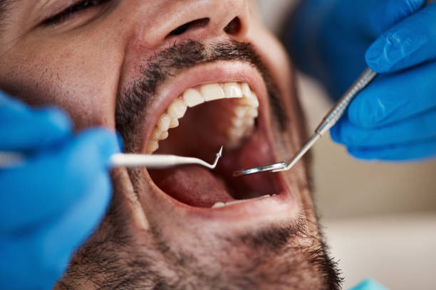 Best Emergency Dentist for Lost Fillings or Crowns in Country Squire Lakes, IN